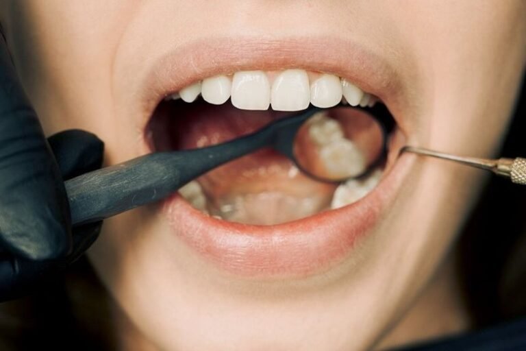 Hva Er Veneers? En Guidet Til Tannestetikk